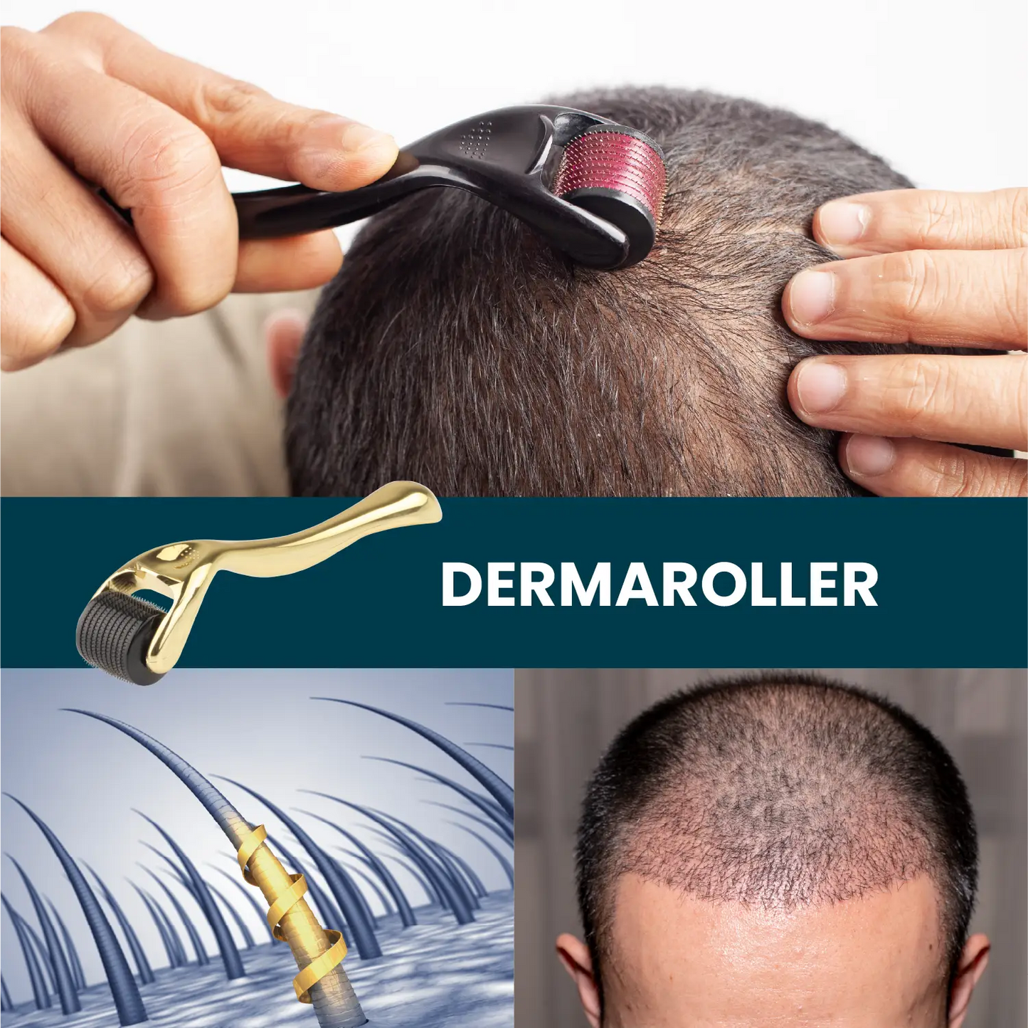 Dermaroller Titanium 1 mm 540 micro-naalden